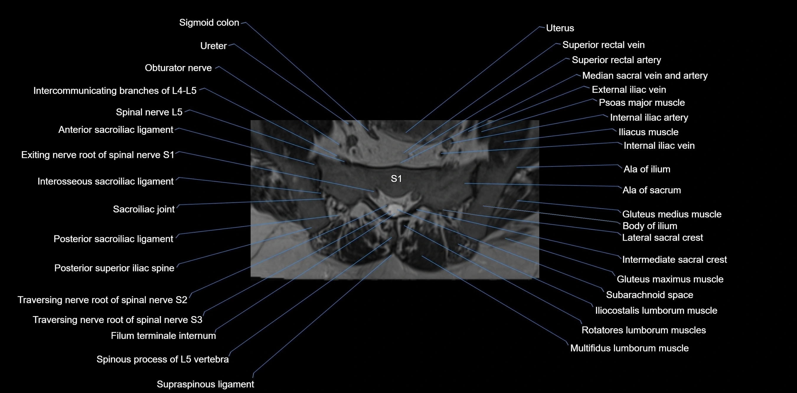 MRI sacrum, coccyx and sacroiliac joint axial cross sectional anatomy 3T  radiology  image-img-00001-00015.webp